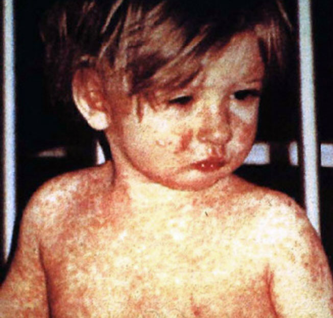 Odra: Niebezpieczna choroba zakaźna czy zwykła infekcja wieku dziecięcego?