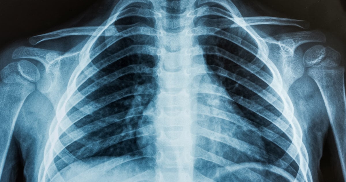 Odma płucna (Odma opłucnowa): przyczyny, objawy, leczenie, powikłania