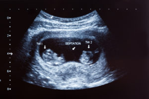 Ciąża bliźniacza jednokosmówkowa dwuowodniowa