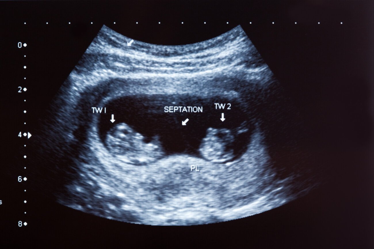 Ciąża bliźniacza jednokosmówkowa dwuowodniowa (1K2O) – szczególny przypadek ciąży mnogiej
