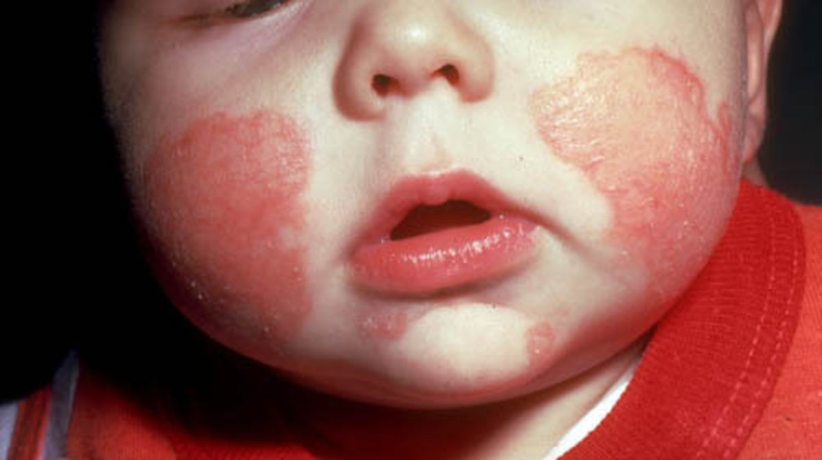 Wysypka na twarzy u dziecka: 7 najczęstszych przyczyn wysypki na buzi