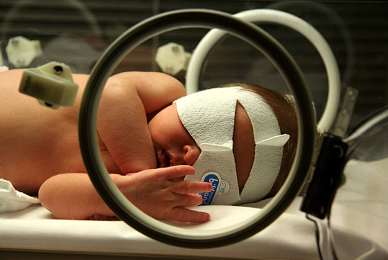 Bilirubina u noworodka: Jakie konsekwencje dla dziecka może mieć żółtaczka?